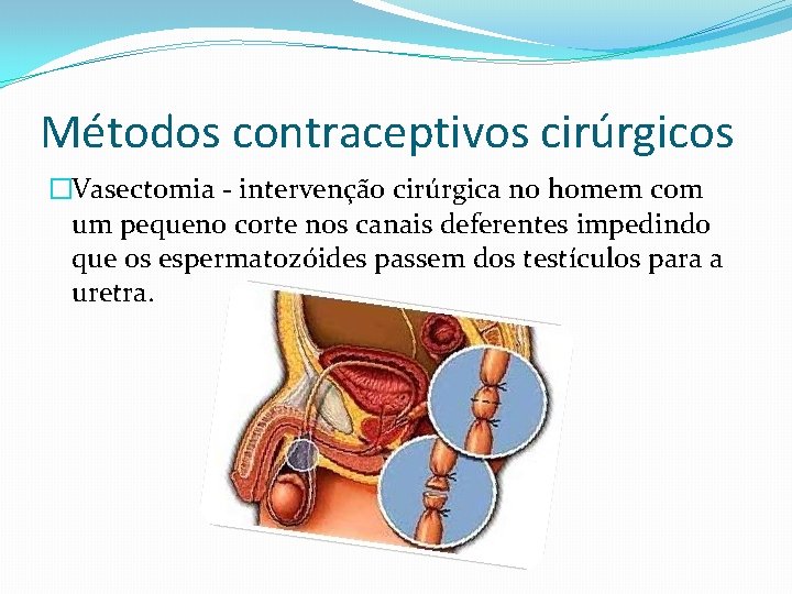 Métodos contraceptivos cirúrgicos �Vasectomia - intervenção cirúrgica no homem com um pequeno corte nos