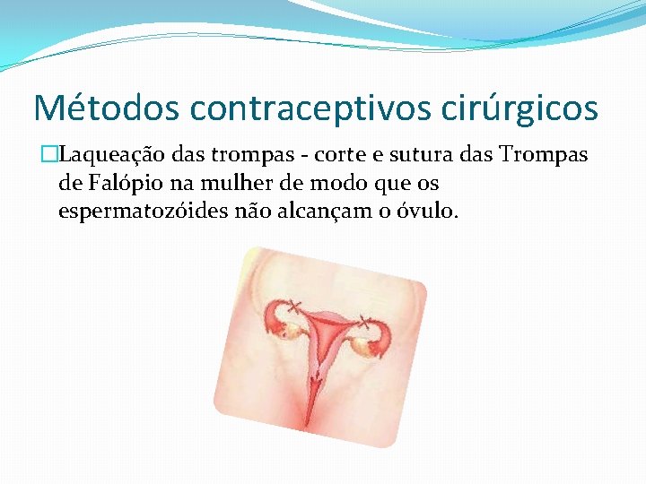 Métodos contraceptivos cirúrgicos �Laqueação das trompas - corte e sutura das Trompas de Falópio