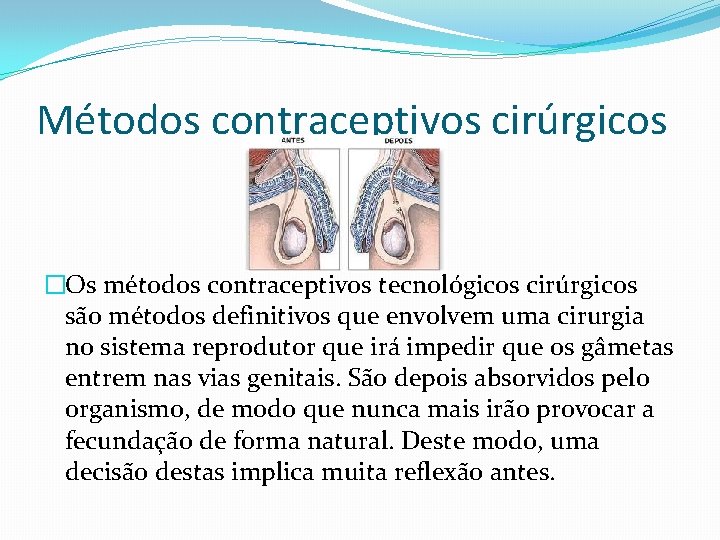 Métodos contraceptivos cirúrgicos �Os métodos contraceptivos tecnológicos cirúrgicos são métodos definitivos que envolvem uma