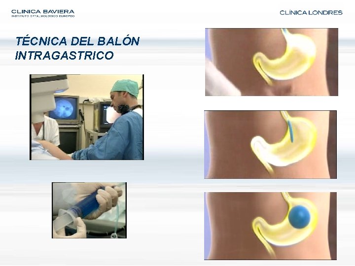 TÉCNICA DEL BALÓN INTRAGASTRICO 
