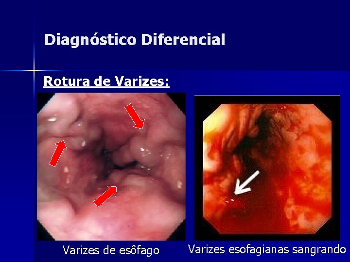 Diagnóstico Diferencial Rotura de Varizes: Varizes de esôfago Varizes esofagianas sangrando 