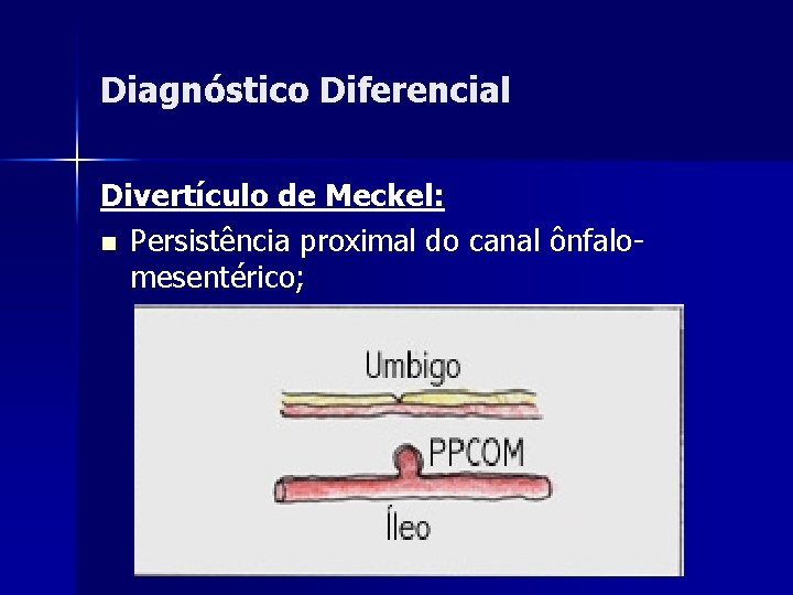 Diagnóstico Diferencial Divertículo de Meckel: n Persistência proximal do canal ônfalomesentérico; 
