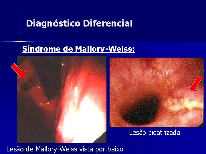 Diagnóstico Diferencial Síndrome de Mallory-Weiss: Lesão cicatrizada Lesão de Mallory-Weiss vista por baixo 