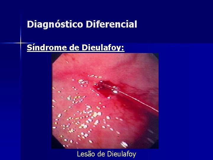 Diagnóstico Diferencial Síndrome de Dieulafoy: Lesão de Dieulafoy 
