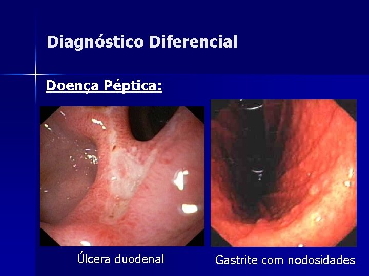 Diagnóstico Diferencial Doença Péptica: Úlcera duodenal Gastrite com nodosidades 