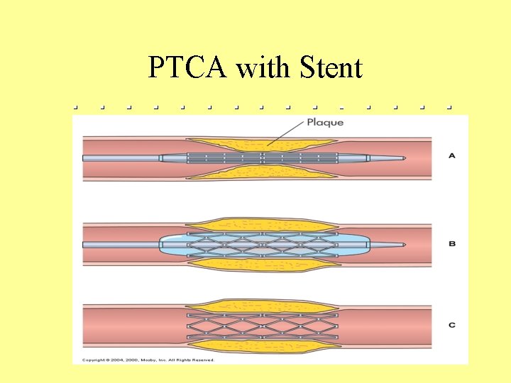 PTCA with Stent 