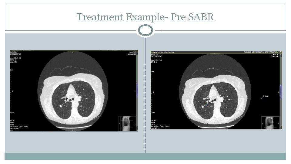 Treatment Example- Pre SABR 