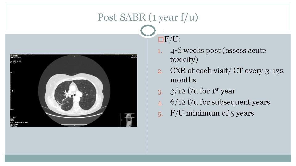 Post SABR (1 year f/u) �F/U: 1. 2. 3. 4. 5. 4 -6 weeks