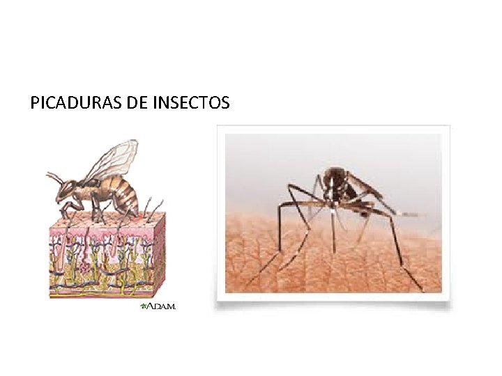 PICADURAS DE INSECTOS 