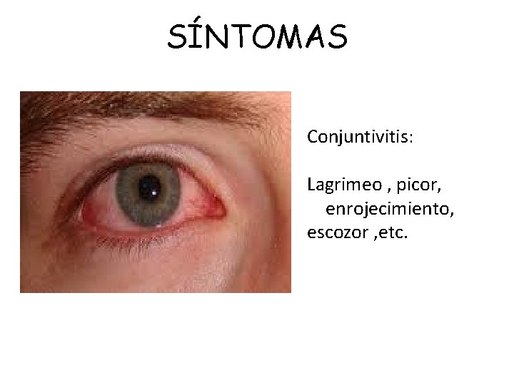 SÍNTOMAS Conjuntivitis: Lagrimeo , picor, enrojecimiento, escozor , etc. 