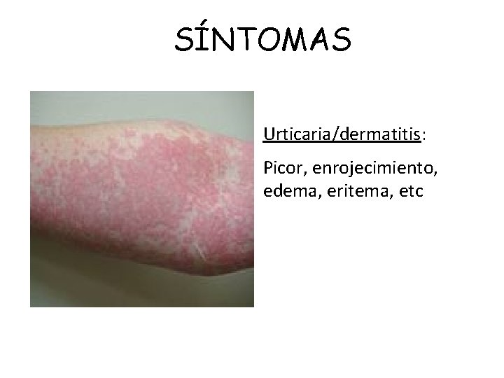 SÍNTOMAS Urticaria/dermatitis: Picor, enrojecimiento, edema, eritema, etc 