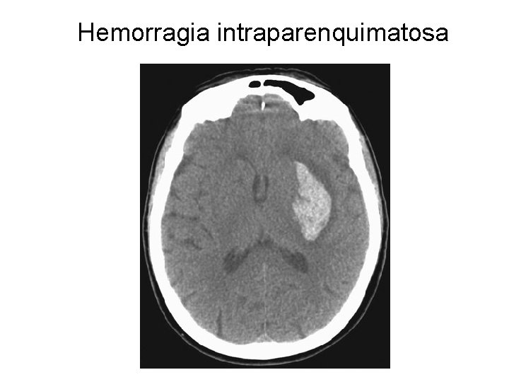 Hemorragia intraparenquimatosa 