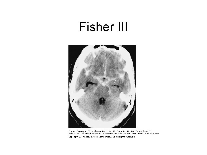 Fisher III 