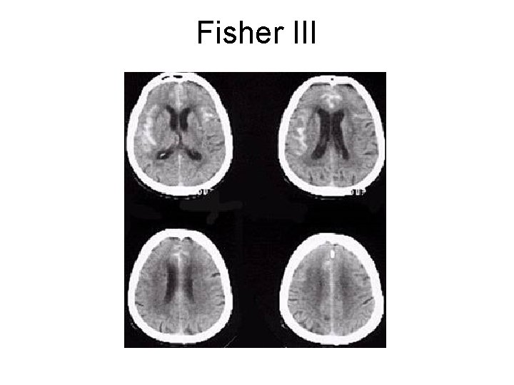 Fisher III 