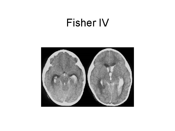 Fisher IV 