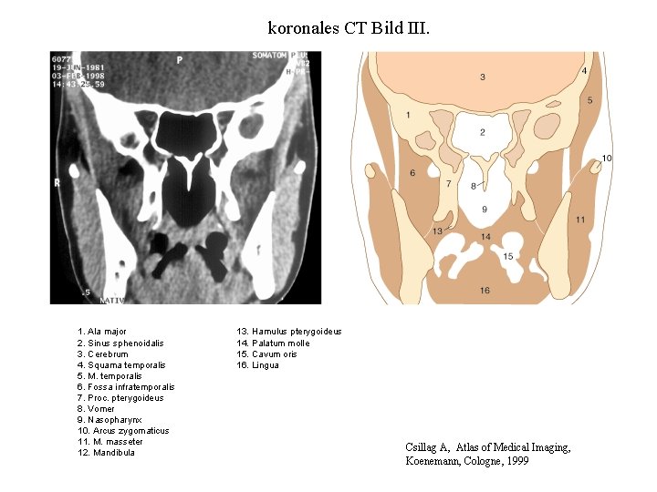 koronales CT Bild III. 1. Ala major 2. Sinus sphenoidalis 3. Cerebrum 4. Squama