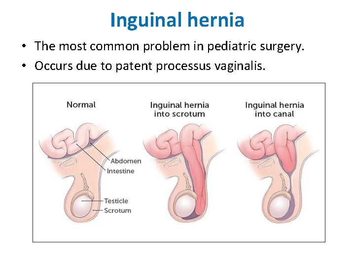Inguinal hernia • The most common problem in pediatric surgery. • Occurs due to