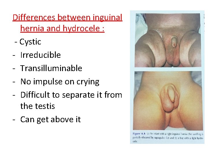 Differences between inguinal hernia and hydrocele : - Cystic - Irreducible - Transilluminable -