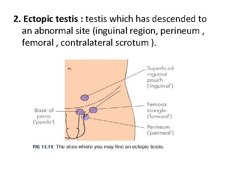 2. Ectopic testis : testis which has descended to an abnormal site (inguinal region,