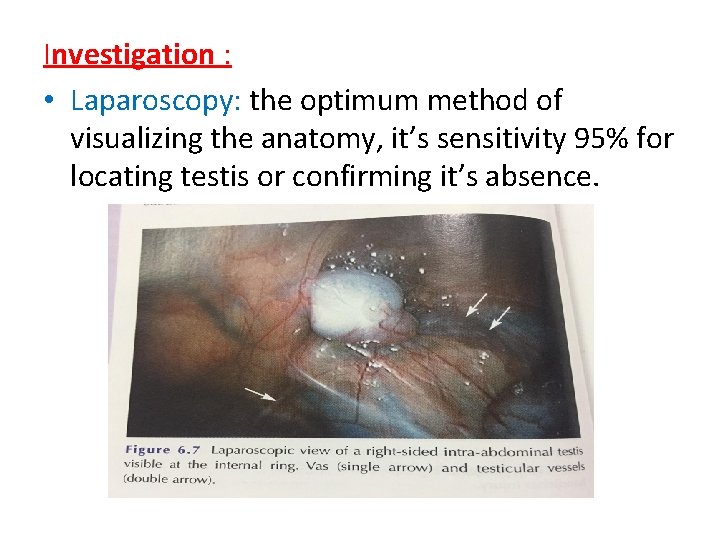 Investigation : • Laparoscopy: the optimum method of visualizing the anatomy, it’s sensitivity 95%