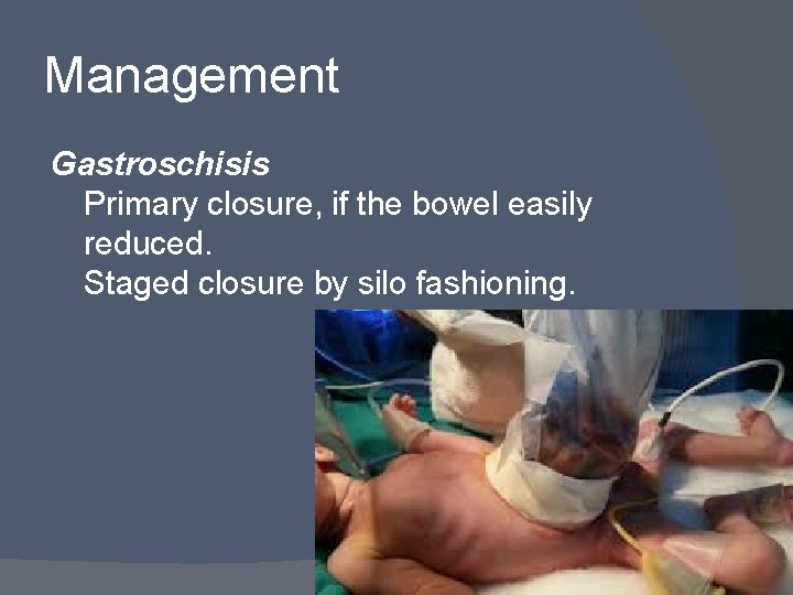 Management Gastroschisis Primary closure, if the bowel easily reduced. Staged closure by silo fashioning.