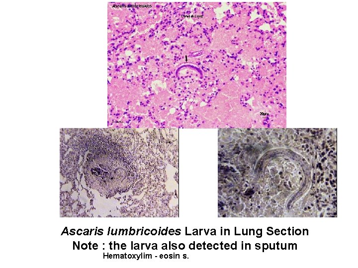 Ascaris lumbricoides Larva in Lung Section Note : the larva also detected in sputum