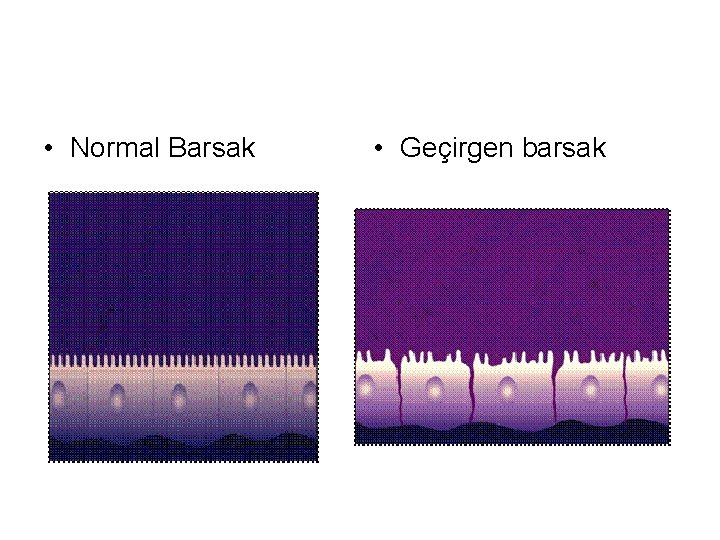  • Normal Barsak • Geçirgen barsak 