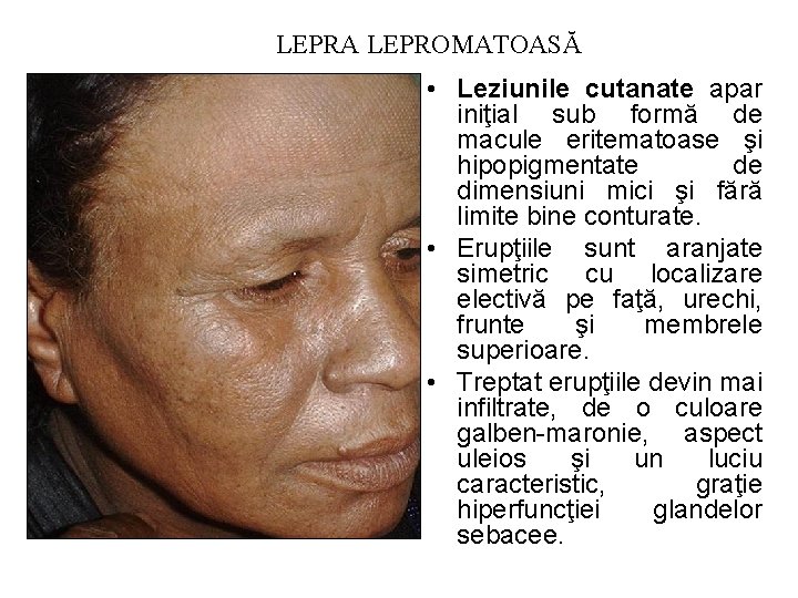 LEPRA LEPROMATOASĂ • Leziunile cutanate apar iniţial sub formă de macule eritematoase şi hipopigmentate