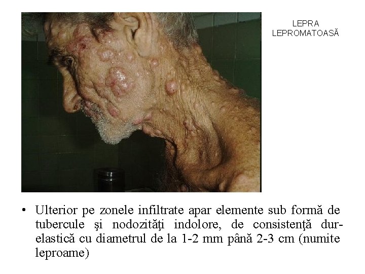 LEPRA LEPROMATOASĂ • Ulterior pe zonele infiltrate apar elemente sub formă de tubercule şi