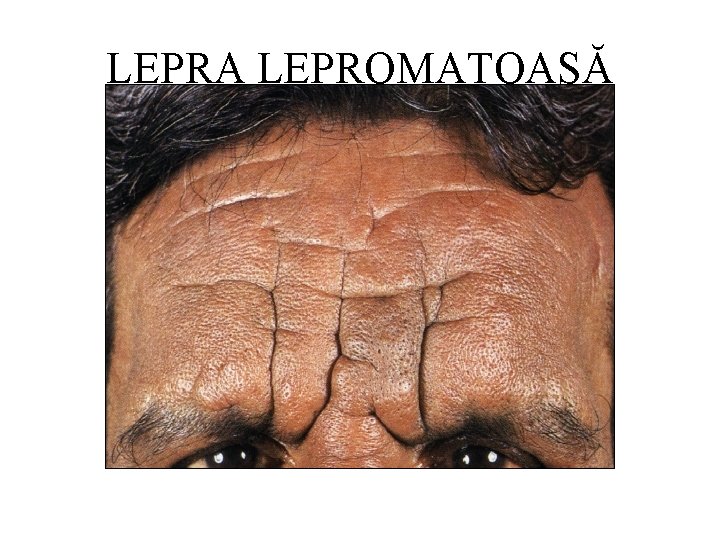 LEPRA LEPROMATOASĂ 