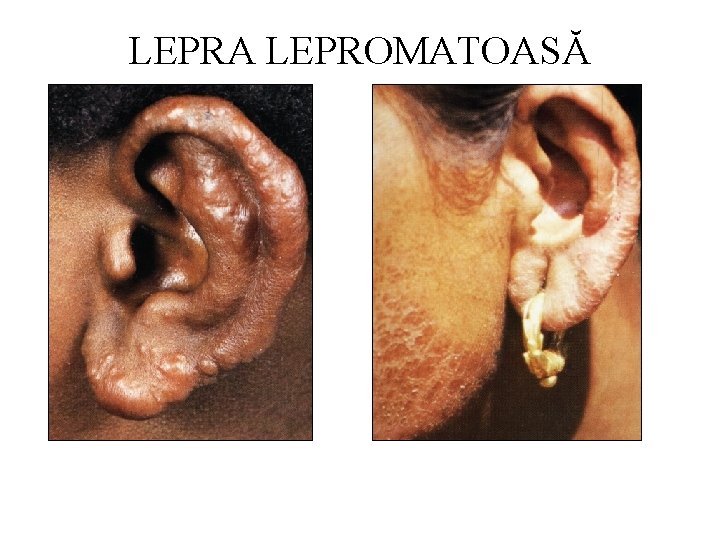 LEPRA LEPROMATOASĂ 