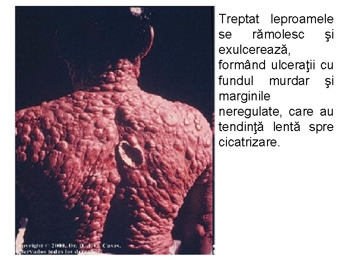  • Treptat leproamele se rămolesc şi exulcerează, formând ulceraţii cu fundul murdar şi