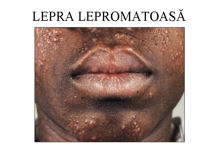 LEPRA LEPROMATOASĂ 