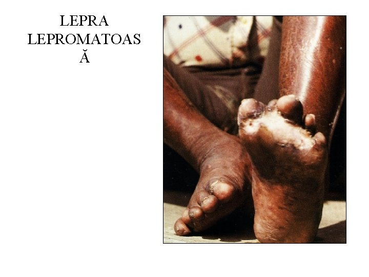 LEPRA LEPROMATOAS Ă 