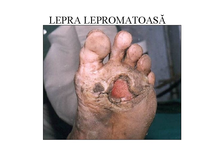 LEPRA LEPROMATOASĂ 