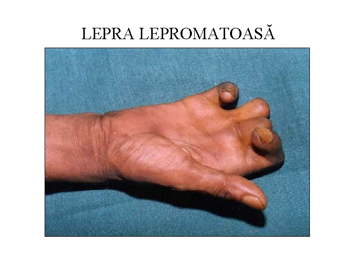 LEPRA LEPROMATOASĂ 