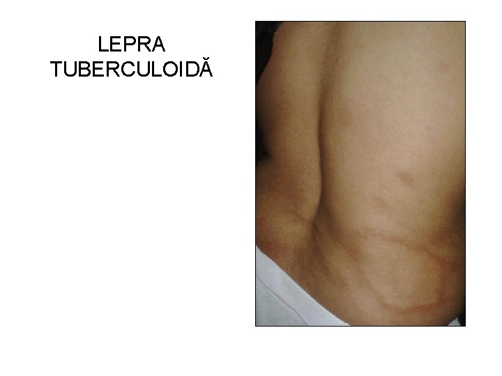 LEPRA TUBERCULOIDĂ 