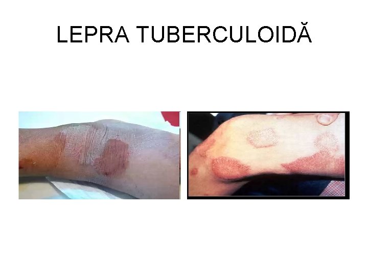 LEPRA TUBERCULOIDĂ 