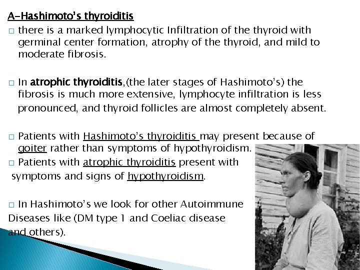 A-Hashimoto’s thyroiditis � there is a marked lymphocytic Infiltration of the thyroid with germinal