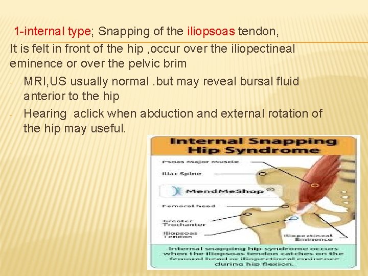 1 -internal type; Snapping of the iliopsoas tendon, It is felt in front of