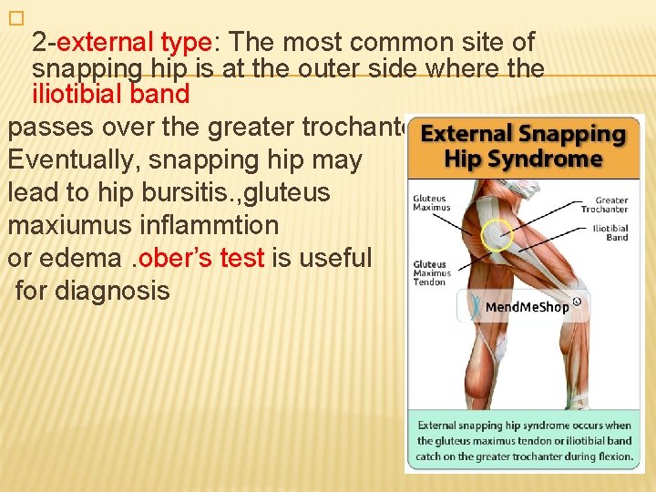 � 2 -external type: The most common site of snapping hip is at the
