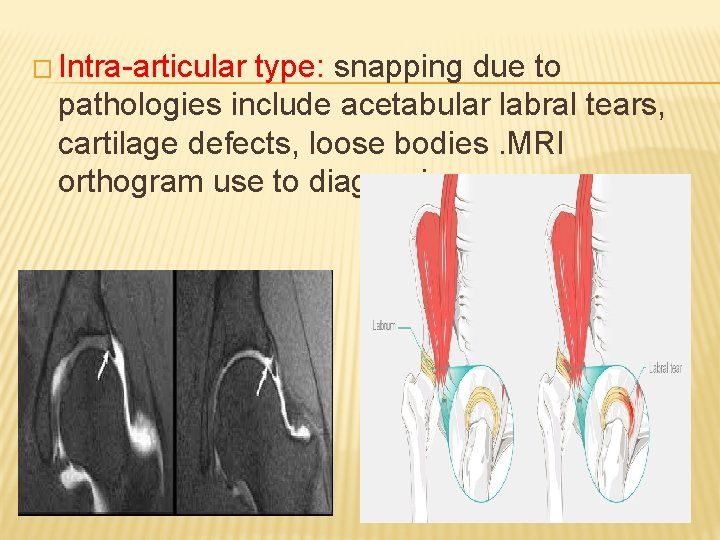 � Intra-articular type: snapping due to pathologies include acetabular labral tears, cartilage defects, loose