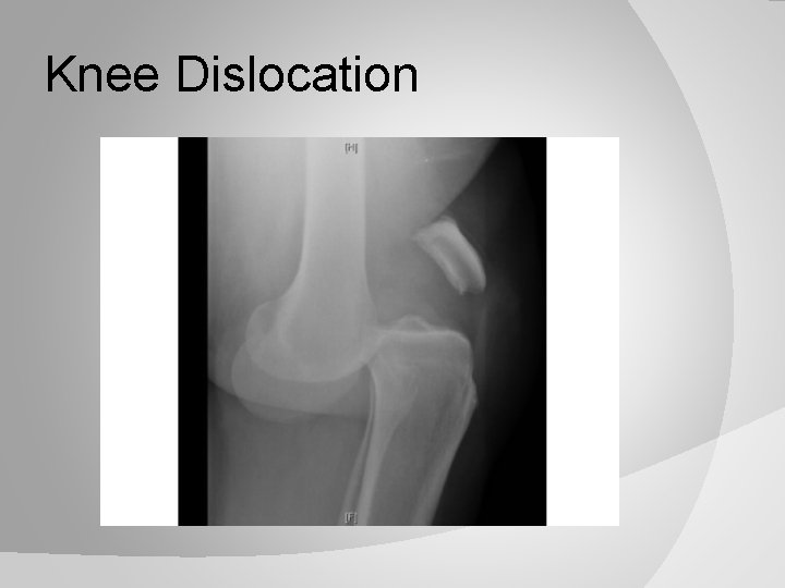 Knee Dislocation 