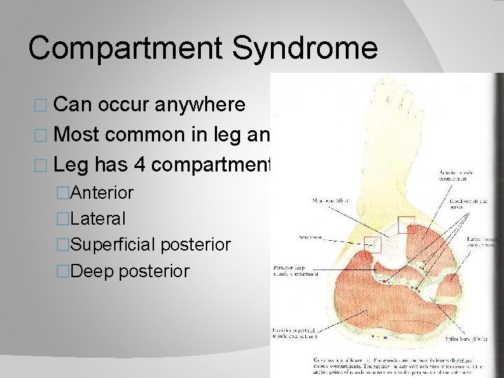 Compartment Syndrome � Can occur anywhere � Most common in leg and forearm �