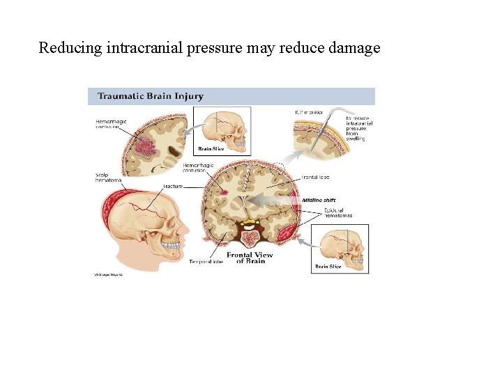 Reducing intracranial pressure may reduce damage 
