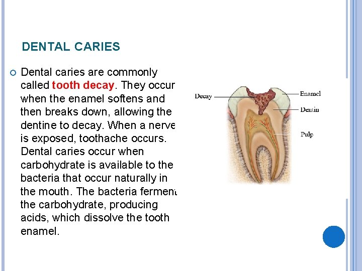 DENTAL CARIES Dental caries are commonly called tooth decay. They occur when the enamel