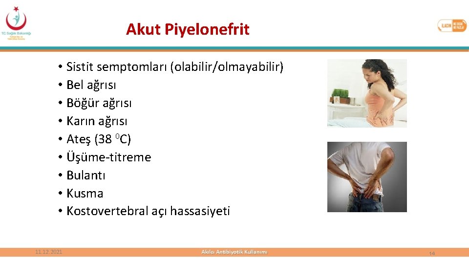 Akut Piyelonefrit • Sistit semptomları (olabilir/olmayabilir) • Bel ağrısı • Böğür ağrısı • Karın