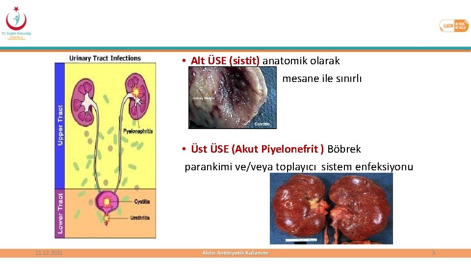  • Alt ÜSE (sistit) anatomik olarak mesane ile sınırlı • Üst ÜSE (Akut