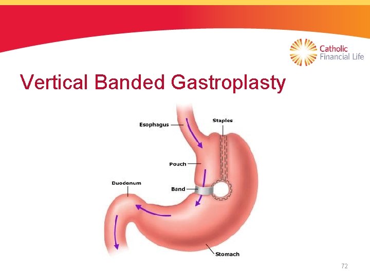 Vertical Banded Gastroplasty 72 