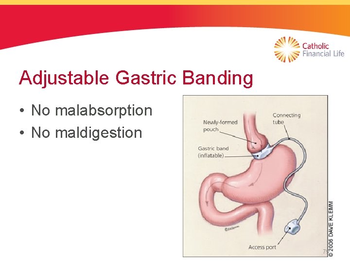 Adjustable Gastric Banding • No malabsorption • No maldigestion 75 